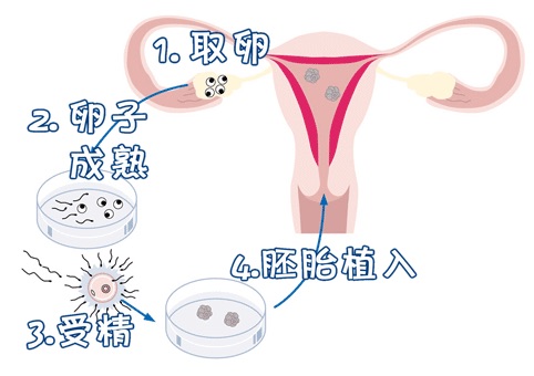 第三代试管婴儿